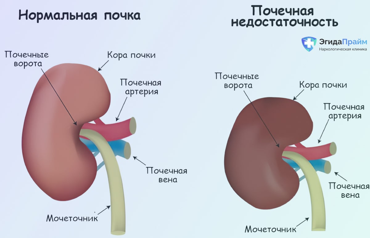 Инфографика почечная недостаточность